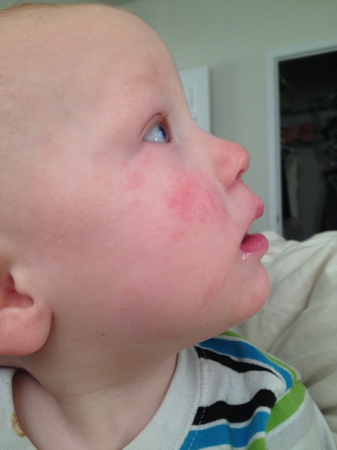 This flair up reappeared just two days after not using Eczema Butter.
